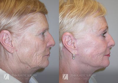 Facelift Before & After Gallery - Patient 106400539 - Image 2
