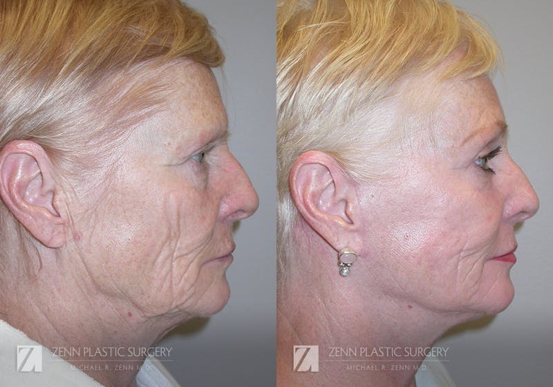 Facelift Before & After Gallery - Patient 106400539 - Image 2