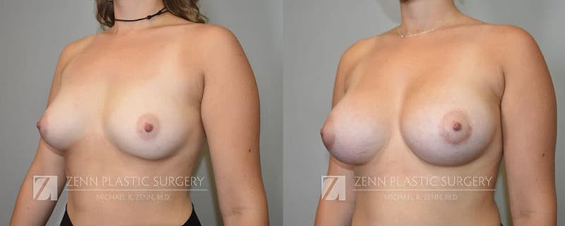 Breast Augmentation Before & After Gallery - Patient 106400540 - Image 3