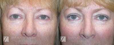 Blepharoplasty / Browlift Before & After Gallery - Patient 106400543 - Image 1
