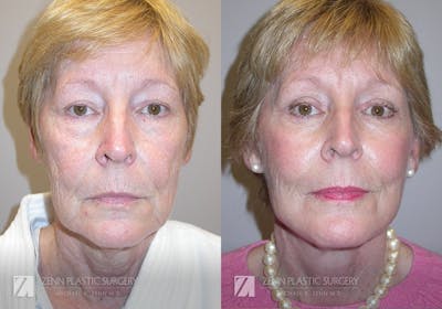 Facelift Before & After Gallery - Patient 106400545 - Image 1