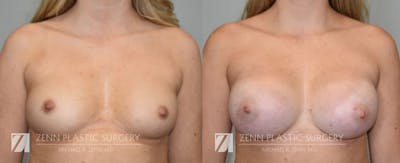Breast Augmentation Before & After Gallery - Patient 106400544 - Image 1
