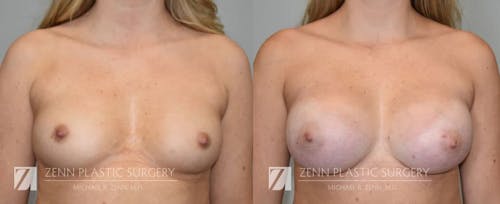 Gallery Before Image