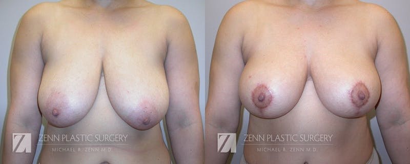 Breast Lift Before & After Gallery - Patient 106400546 - Image 1