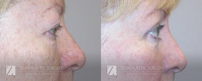 Blepharoplasty / Browlift Before & After Gallery - Patient 106400543 - Image 2