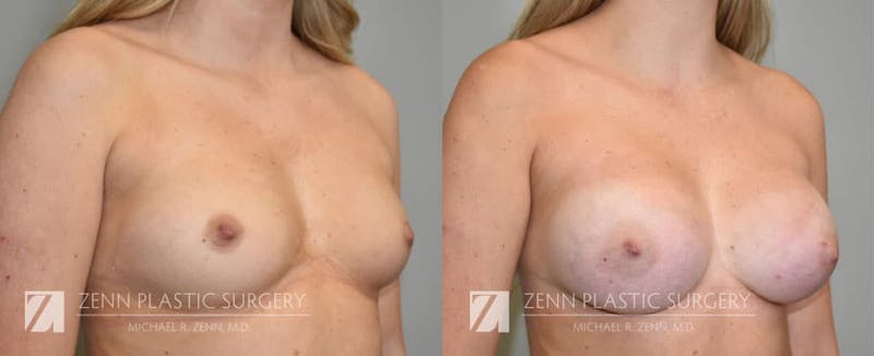 Breast Augmentation Before & After Gallery - Patient 106400544 - Image 2