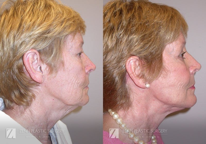 Facelift Before & After Gallery - Patient 106400545 - Image 2