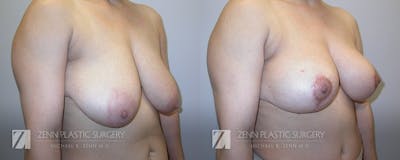 Breast Lift Before & After Gallery - Patient 106400546 - Image 2