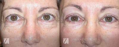 Blepharoplasty / Browlift Before & After Gallery - Patient 106400548 - Image 1
