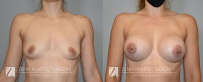 Breast Augmentation Before & After Gallery - Patient 106400547 - Image 1