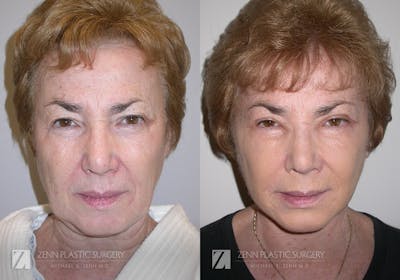 Facelift Before & After Gallery - Patient 106400549 - Image 1