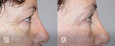 Blepharoplasty / Browlift Before & After Gallery - Patient 106400548 - Image 2