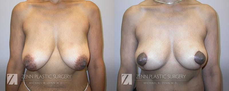 Breast Lift Before & After Gallery - Patient 106400550 - Image 1