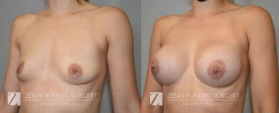 Breast Augmentation Before & After Gallery - Patient 106400547 - Image 2