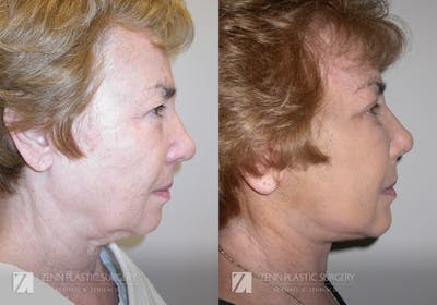 Facelift Before & After Gallery - Patient 106400549 - Image 2