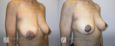 Breast Lift Before & After Gallery - Patient 106400550 - Image 2