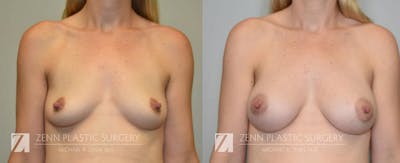 Breast Augmentation Before & After Gallery - Patient 106400551 - Image 1