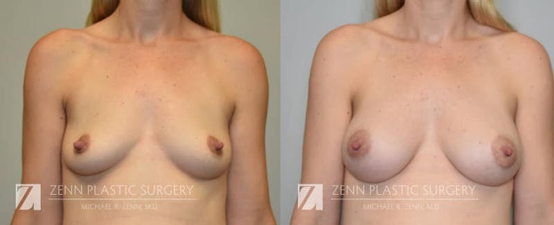 Breast Augmentation Before & After Gallery - Patient 106400551 - Image 1