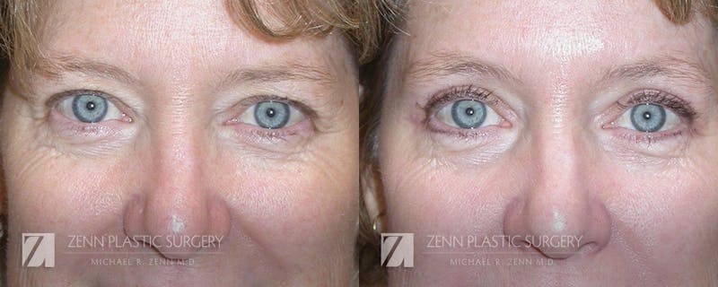 Blepharoplasty / Browlift Before & After Gallery - Patient 106400552 - Image 1