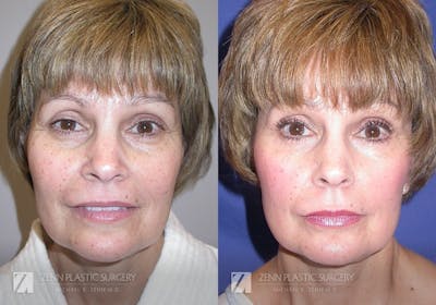 Facelift Before & After Gallery - Patient 106400555 - Image 1