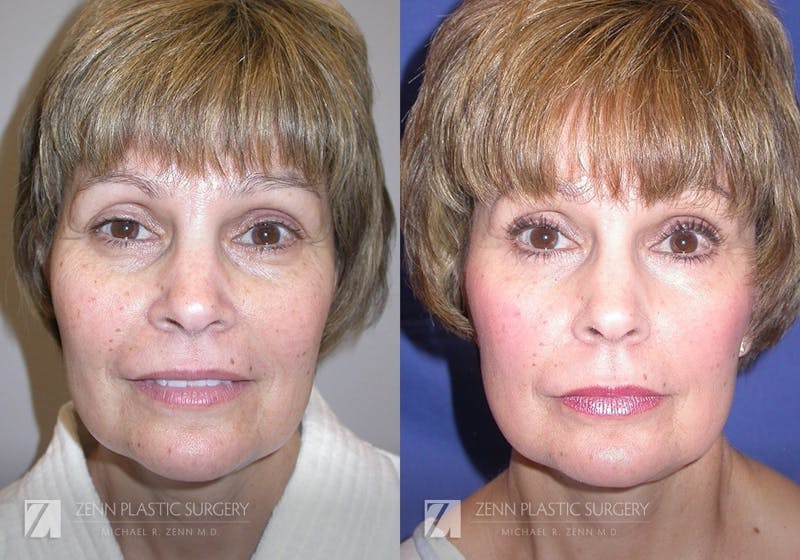 Facelift Before & After Gallery - Patient 106400555 - Image 1