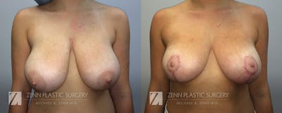 Breast Reduction Before & After Gallery - Patient 106400553 - Image 1