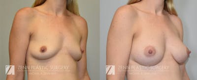 Breast Augmentation Before & After Gallery - Patient 106400551 - Image 2