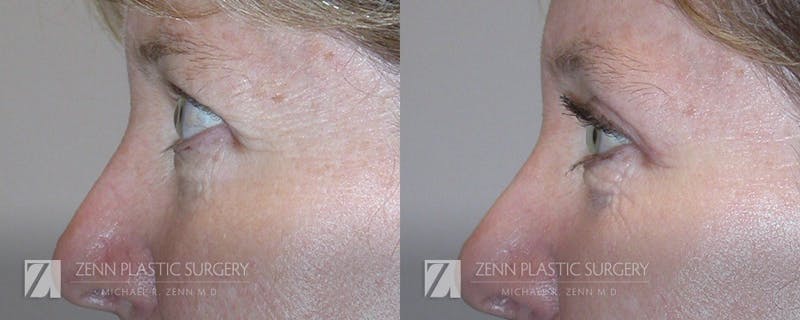 Blepharoplasty / Browlift Before & After Gallery - Patient 106400552 - Image 2