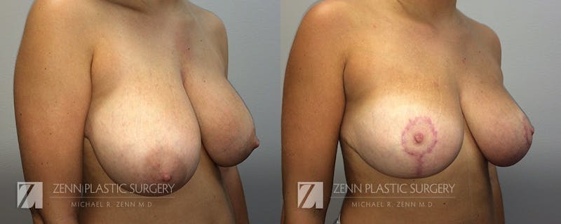 Breast Reduction Before & After Gallery - Patient 106400553 - Image 2