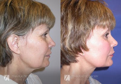 Facelift Before & After Gallery - Patient 106400555 - Image 2
