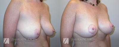 Breast Lift Before & After Gallery - Patient 106400554 - Image 2