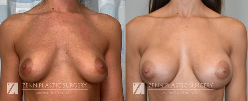 Breast Augmentation Before & After Gallery - Patient 106400556 - Image 1