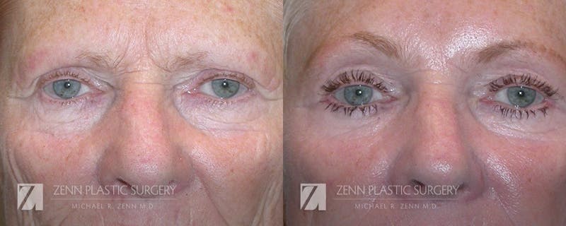Blepharoplasty / Browlift Before & After Gallery - Patient 106400557 - Image 1