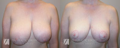 Breast Reduction Before & After Gallery - Patient 106400558 - Image 1