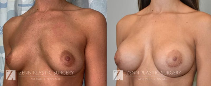 Breast Augmentation Before & After Gallery - Patient 106400556 - Image 2