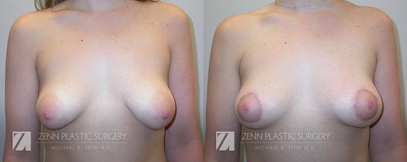 Breast Lift Before & After Gallery - Patient 106400559 - Image 1