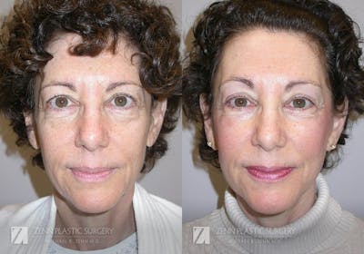 Facelift Before & After Gallery - Patient 106400560 - Image 1