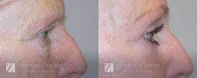 Blepharoplasty / Browlift Before & After Gallery - Patient 106400557 - Image 2