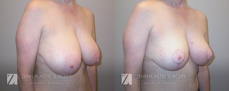 Breast Reduction Before & After Gallery - Patient 106400558 - Image 2