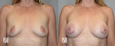 Breast Augmentation Before & After Gallery - Patient 106400561 - Image 1