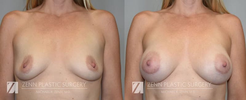 Breast Augmentation Before & After Gallery - Patient 106400561 - Image 1