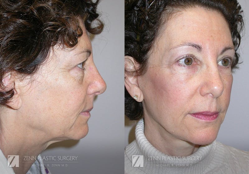 Facelift Before & After Gallery - Patient 106400560 - Image 2