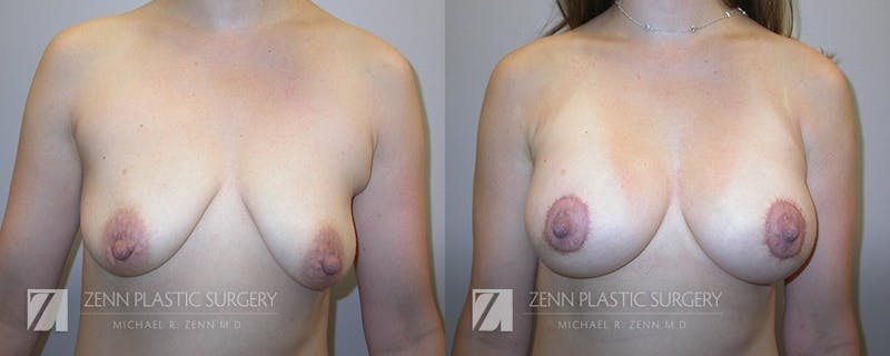 Breast Lift + Implants Before & After Gallery - Patient 106400562 - Image 1
