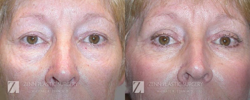 Blepharoplasty / Browlift Before & After Gallery - Patient 106400563 - Image 1