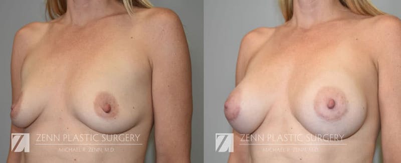Breast Augmentation Before & After Gallery - Patient 106400561 - Image 2