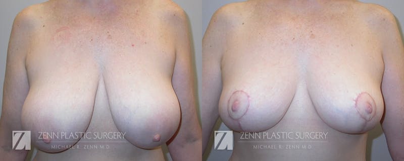 Breast Reduction Before & After Gallery - Patient 106400564 - Image 1