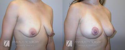 Breast Lift + Implants Before & After Gallery - Patient 106400562 - Image 2