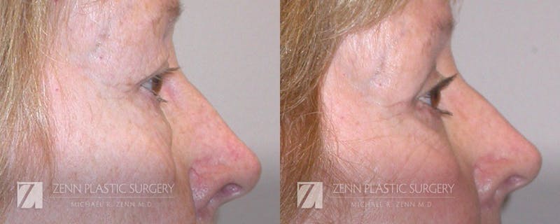 Blepharoplasty / Browlift Before & After Gallery - Patient 106400563 - Image 2