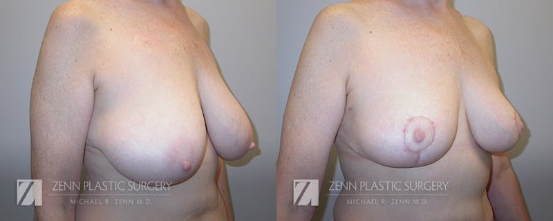 Breast Reduction Before & After Gallery - Patient 106400564 - Image 2