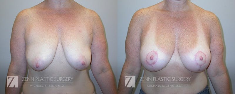 Breast Lift + Implants Before & After Gallery - Patient 106400565 - Image 1
